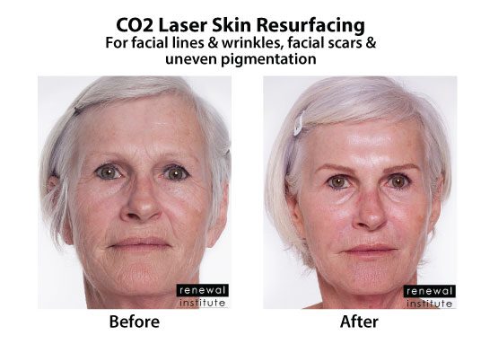 Before And After Co2 Laser Resurfacing Facial Lines Wrinkles And Scars 2