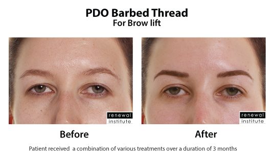 Before And After Pdo Barbed Threads For Brow Lift
