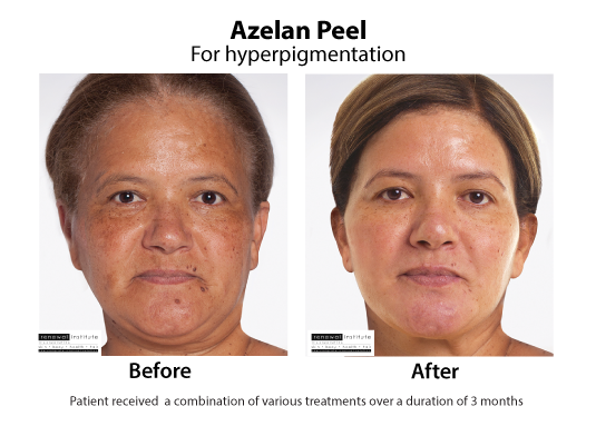 Before And After Azelaic Peels Hyperpigmentation