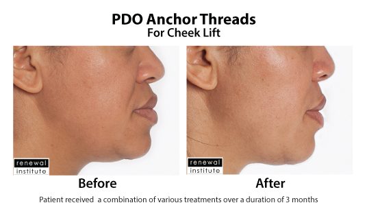 Before And After Pdo Threads For Cheek Lift 5