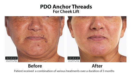 Before And After Pdo Threads For Cheek Lift 6