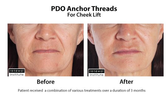 Before And After Pdo Threads For Cheecklift Dark Skin