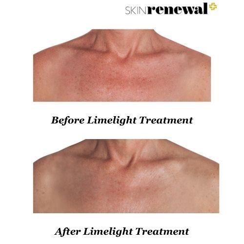 Marissa Before And After Limelight
