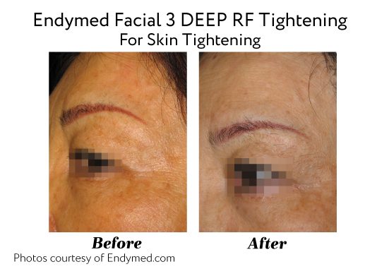 Endymed Before And After Endymed 3deep Rf Skin Tightening Treatments