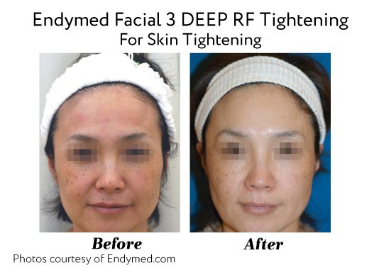 Endymed Before And After Endymed 3deep Rf Skin Tightening
