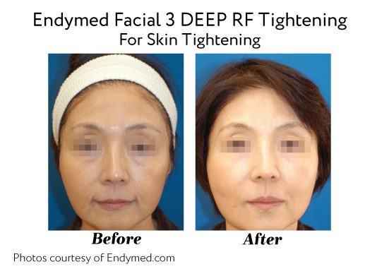 Endymed Before And After Endymed Facial 3 Deep Rf Tightening