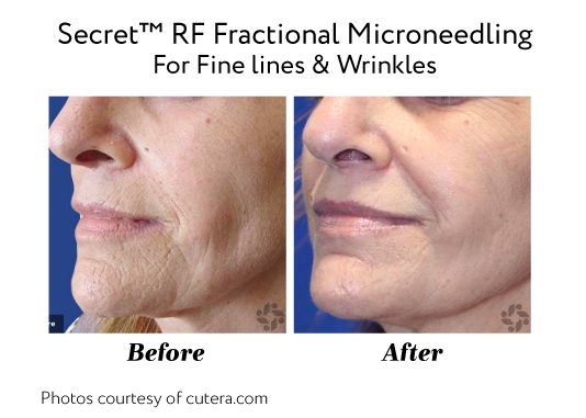 Before After Secrettm Rf Fractional Microneedling For Fine Lines Wrinkles 1
