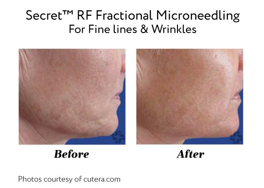 Before After Secrettm Rf Fractional Microneedling For Fine Lines Wrinkles