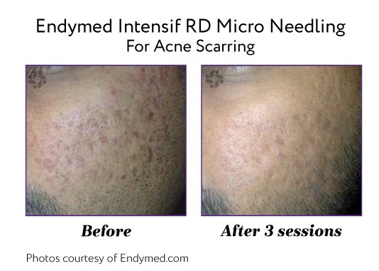 Endymed Before And After Acne Scarring