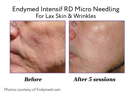 Endymed Before And After Lax Skin Wrinkles