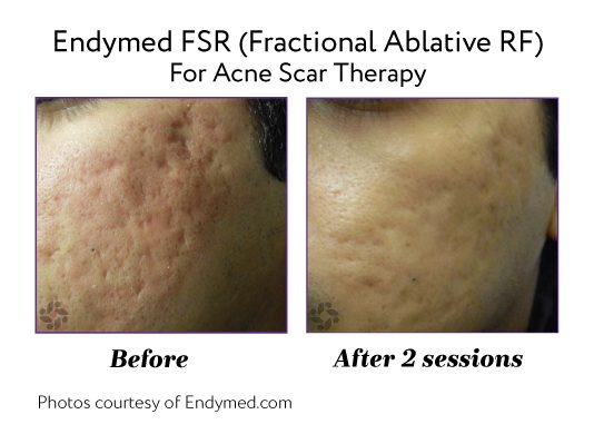 Endymed Before And After Fsr Fractional Ablative Rf For Acne Scar Therapy