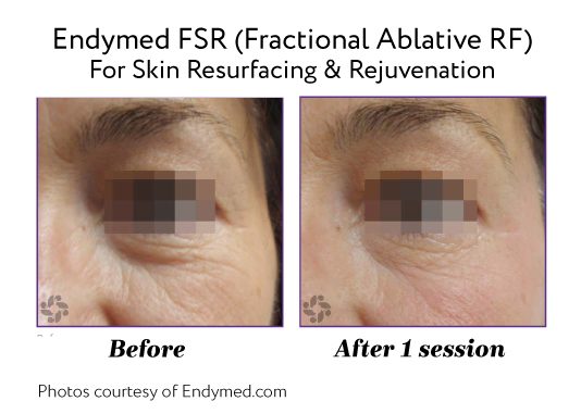 Endymed Before And After Fsr Fractional Ablative Rf For Skin Resurfacing Rejuvenation