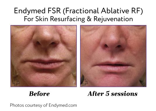 Endymed Before And After Fsr Fractional Ablative Rf Skin Resurfacing Rejuvenation