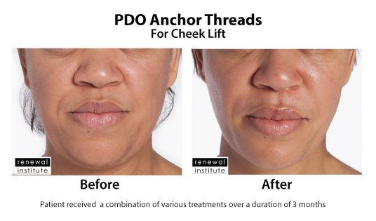 Before And After Pdo Threads For Cheek Lift 4