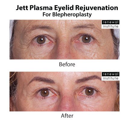Jett Plasma Before After Eyelid Rejuvenation For Blephs 6