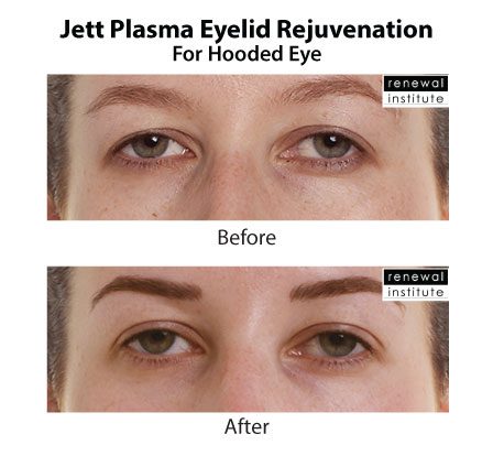Jett Plasma Before After Eyelid Rejuvenation For Hooded Eyes 2