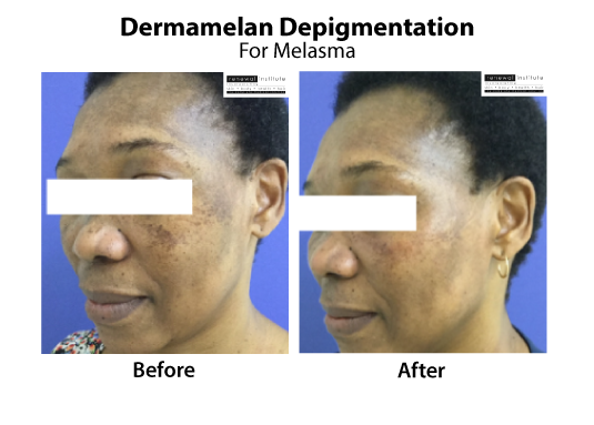 Medical Peels Dermamelan Depigmentation Melasma Treatment Skinrenewal
