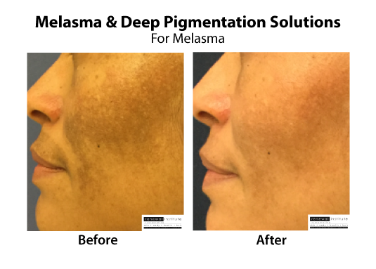 Medical Peels Pigmentation Melasma Treatment Skinrenewal 2