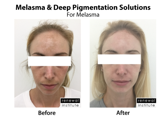 Medical Peels Pigmentation Melasma Treatment Skinrenewal 3