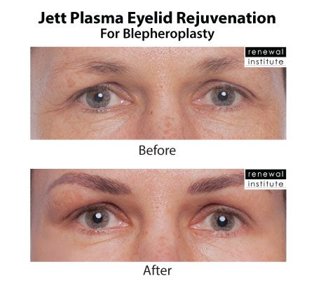 Jett Plasma Before After Eyelid Rejuvenation For Blephs 5