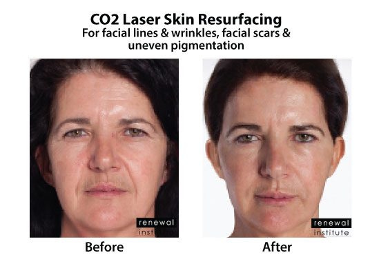 Before And After Co2 Laser Resurfacing Facial Lines Wrinkles And Scars 7