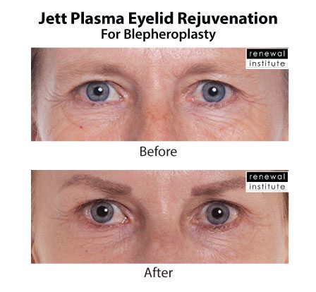 Jett Plasma Before After Eyelid Rejuvenation For Blephs 4