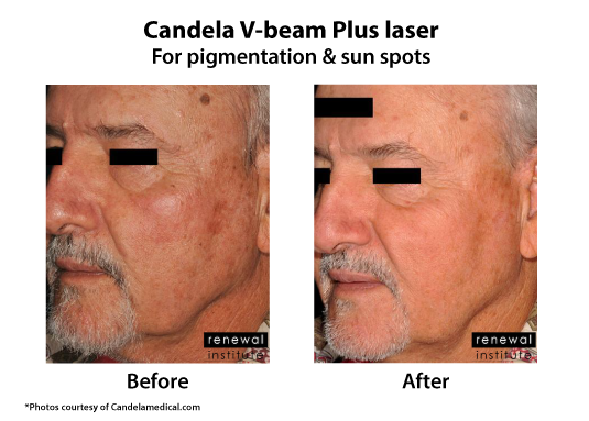 Before And After Vbeamprima Pigmentation And Sun Spots