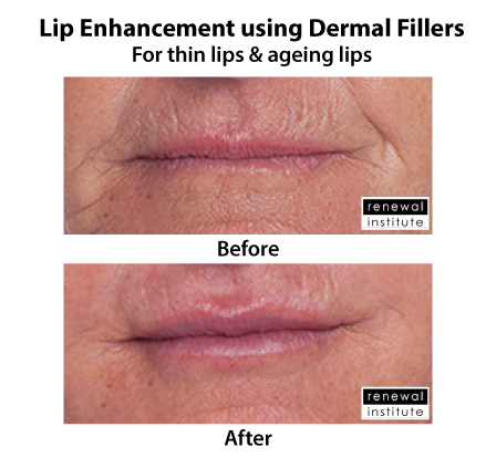 Before And After Dermal Lip Fillers For Lip Rejuvenation 3