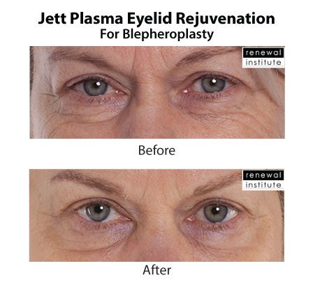 Jett Plasma Before After Eyelid Rejuvenation For Blephs 3