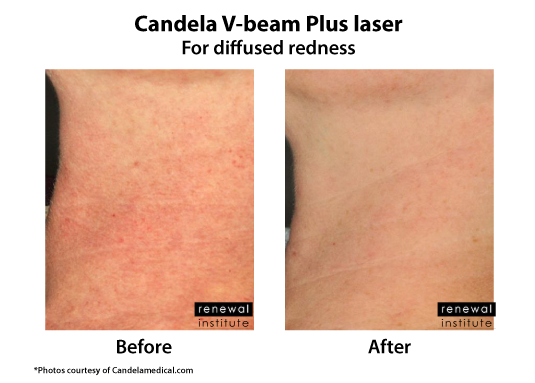 Before And After Vbeam Candela Prima Laser For Redness On Neck