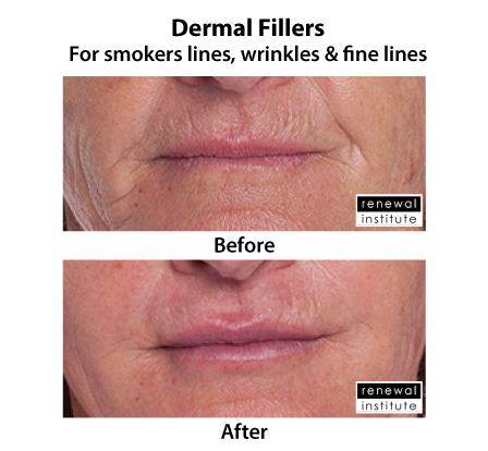 Before And After Dermal Lip Fillers For Lip Rejuvenation 2