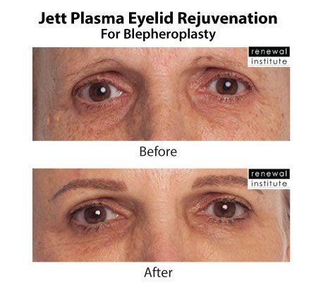 Jett Plasma Before After Eyelid Rejuvenation For Blephs 2