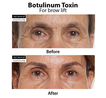 Before And After Botox For Brow Lift