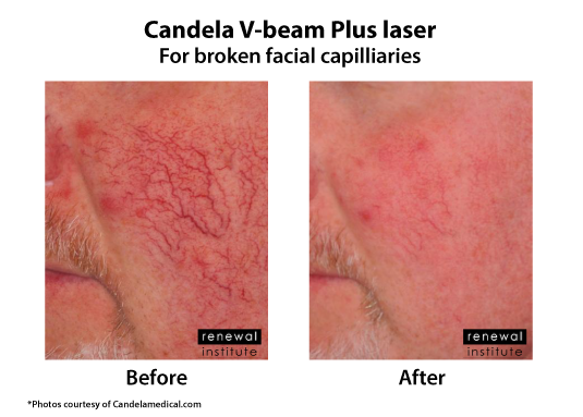 Before And After Vbeam Candela Prima Laser For Facial Veins Capilliaries