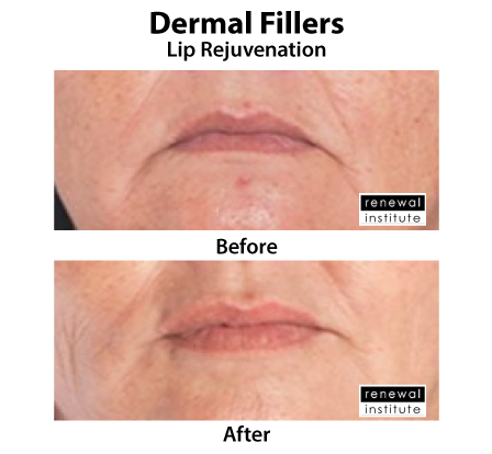 Before And After Dermal Lip Fillers For Lip Rejuvenation 1