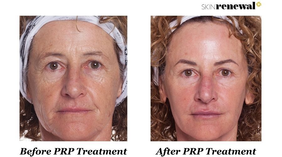 Annie Prp Before And After