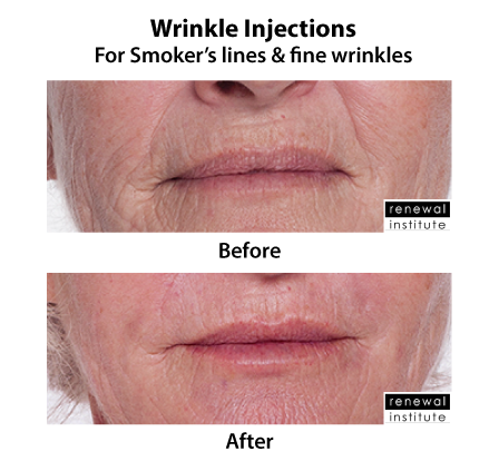 Wrinkle Injections Before And After For Smokers Lines
