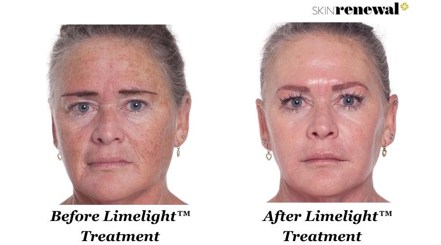 Patricia Limelight Before And After