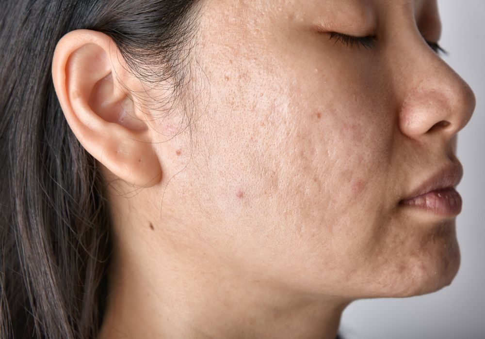 Acne Scarring | Acne Scar Treatments | Skin Renewal