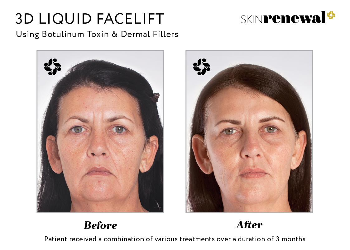 Face-Lift (rhytidectomy) - Conditions & Treatments