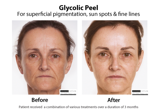 Before And After Glycolic Peels Pigmentation Sun Spots And Fine Lines