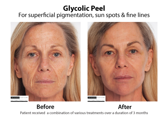 Before And After Glycolic Peels Pigmentation Sun Spots And Fine Lines1 2