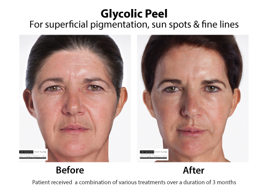 Before And After Glycolic Peels Pigmentation Sun Spots And Fine Lines1 3