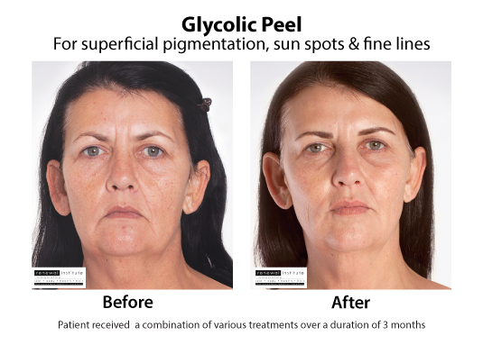 Before And After Glycolic Peels Pigmentation Sun Spots And Fine Lines1 4