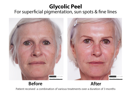 Before And After Glycolic Peels Pigmentation Sun Spots And Fine Lines1