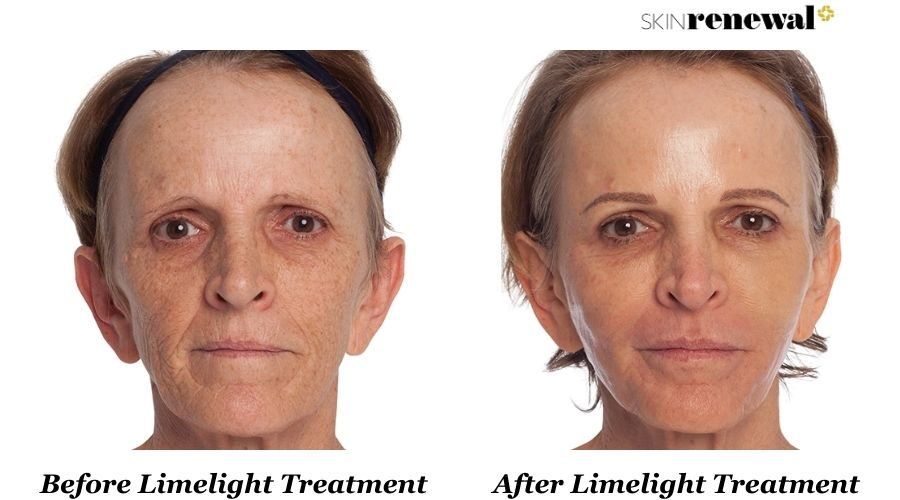 Liana Limelight Before And After