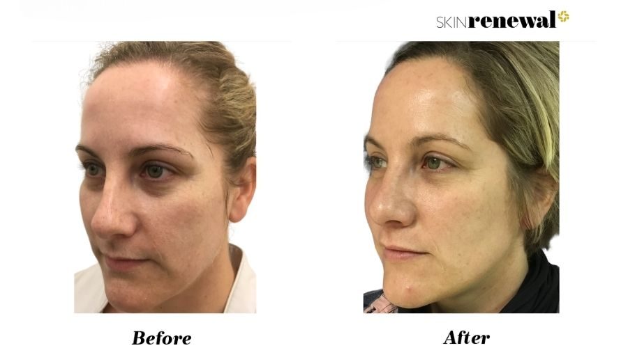 Restylane Dermal Fillers | Hyaluronic Acid | Skin Renewal