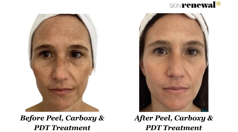 Peel Carboxytherapy Pdt Front