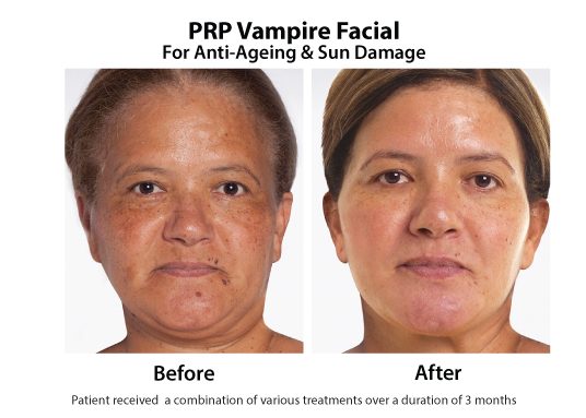 Before And After Dermapen Skin Needling With Prp Ageing Skin 3