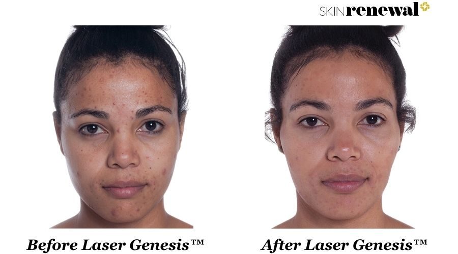 Bianca Laser Genesis Before And After